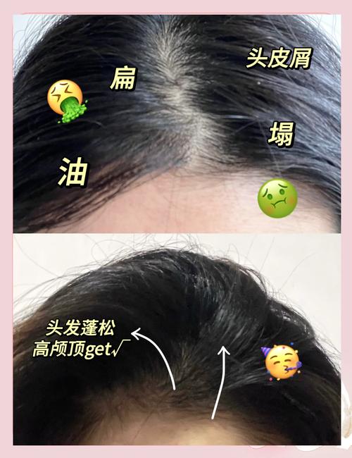 网友:“大油头”、头皮屑、脱发,全齐了……专家:解决办法如下→