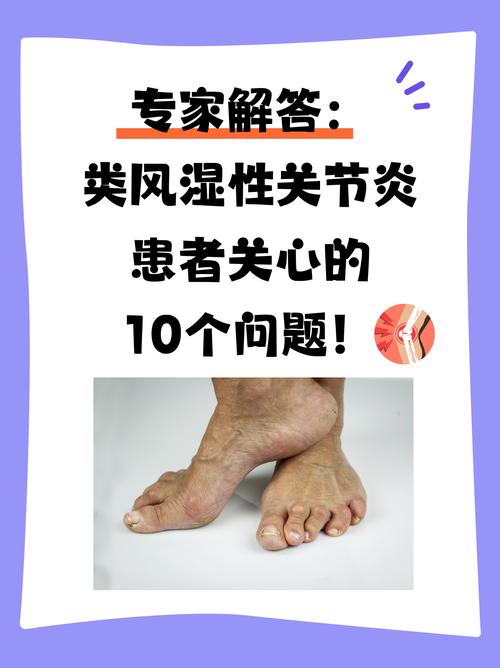 要风度不要温度?那些年受的凉到底和类风湿关节炎有没有关系?看看这6个问题……