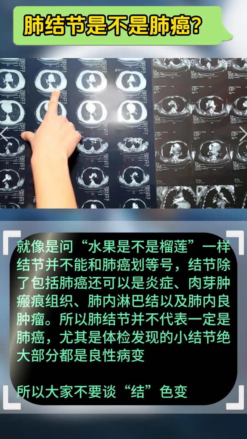 为何不吸烟女性发病率越来越高?磨玻璃结节是什么?关注肺癌防治→