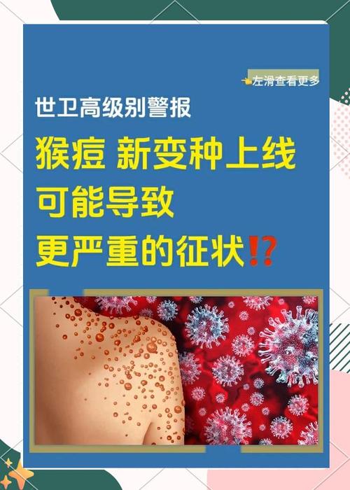 英国猴痘病例增至4例 非洲以外首现集群感染