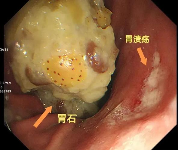 40岁男子胃里长出罕见巨大间质瘤!专家提醒
